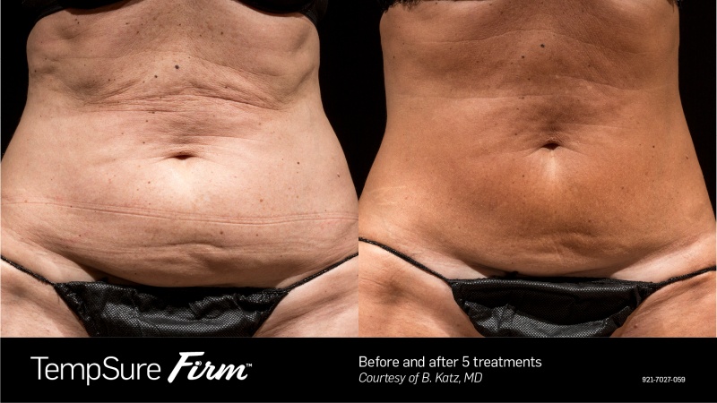 TempSure Firm Before & After
