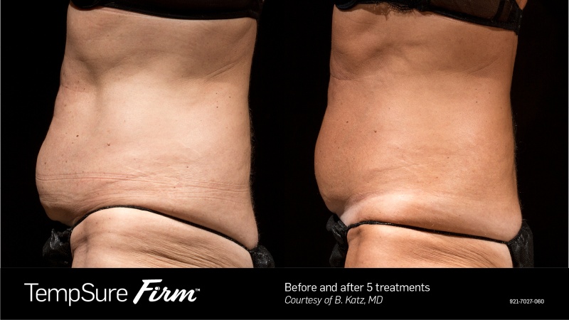 TempSure Firm Before & After