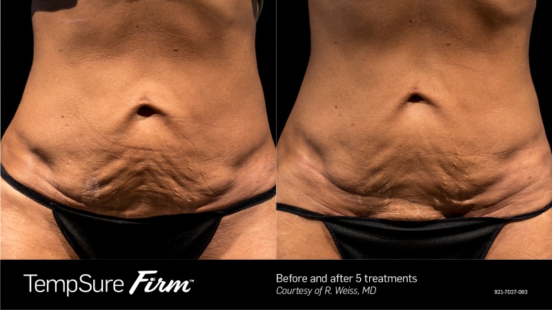 TempSure Firm Before & After