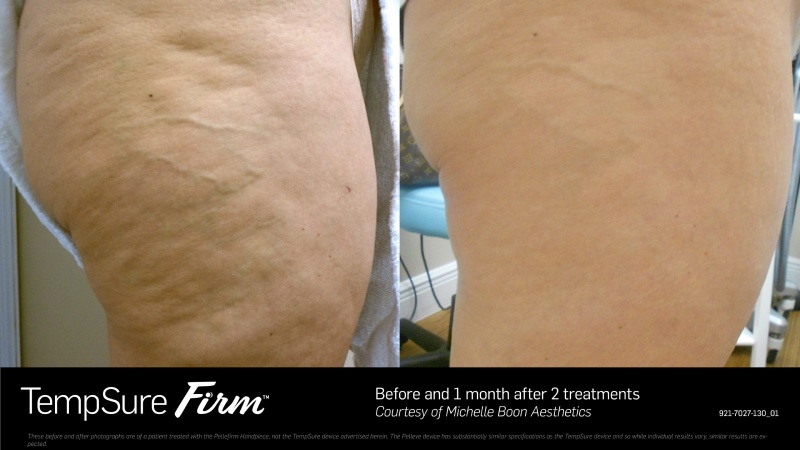 TempSure Firm Before & After