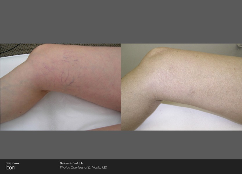 Leg-Vein-Removal-Before-and-After-Photo-1