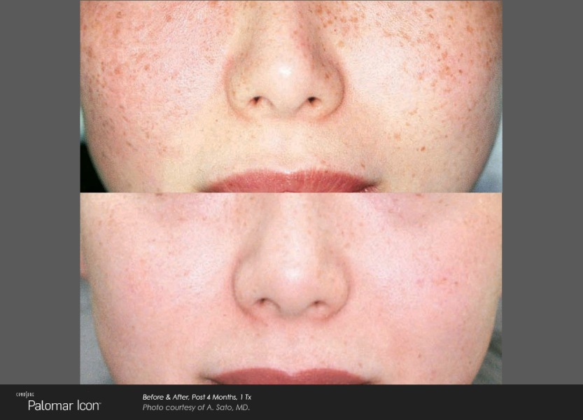 Skin-Revitalization-Before-&-After-Photo-2