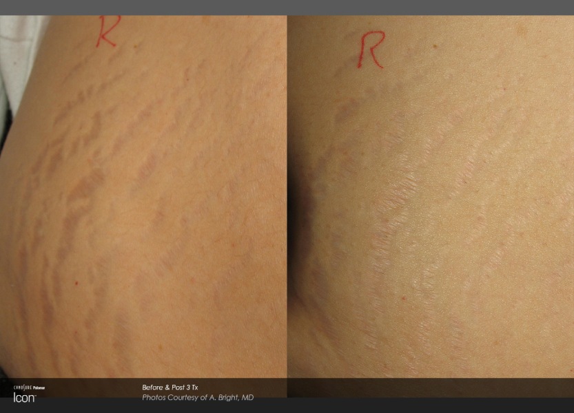 Stretch-Mark-Before-&-After-2_0